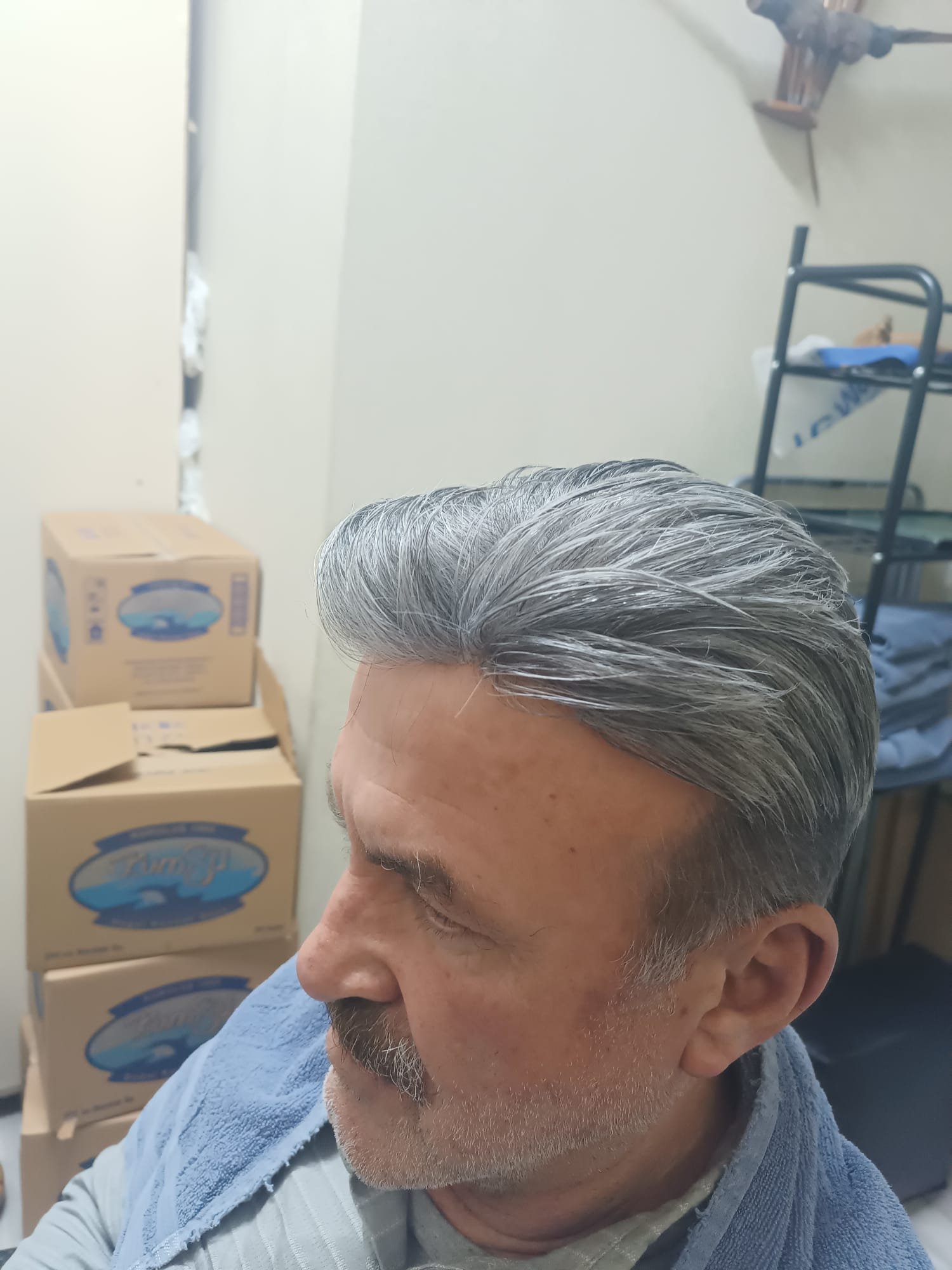 Danışan 01 protez saç çalışması — Eko Hair İstanbul