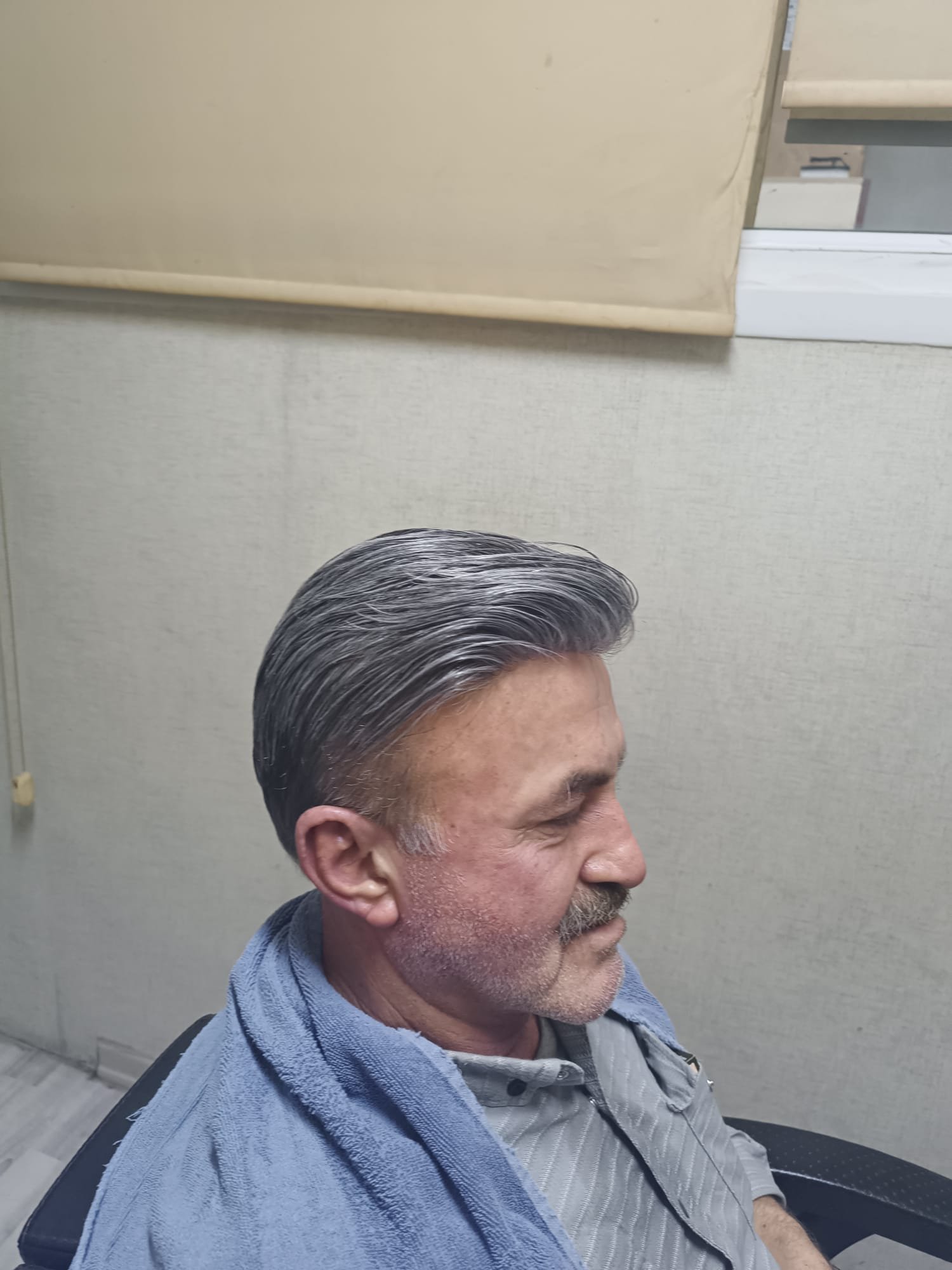 Danışan 01 protez saç çalışması — Eko Hair İstanbul