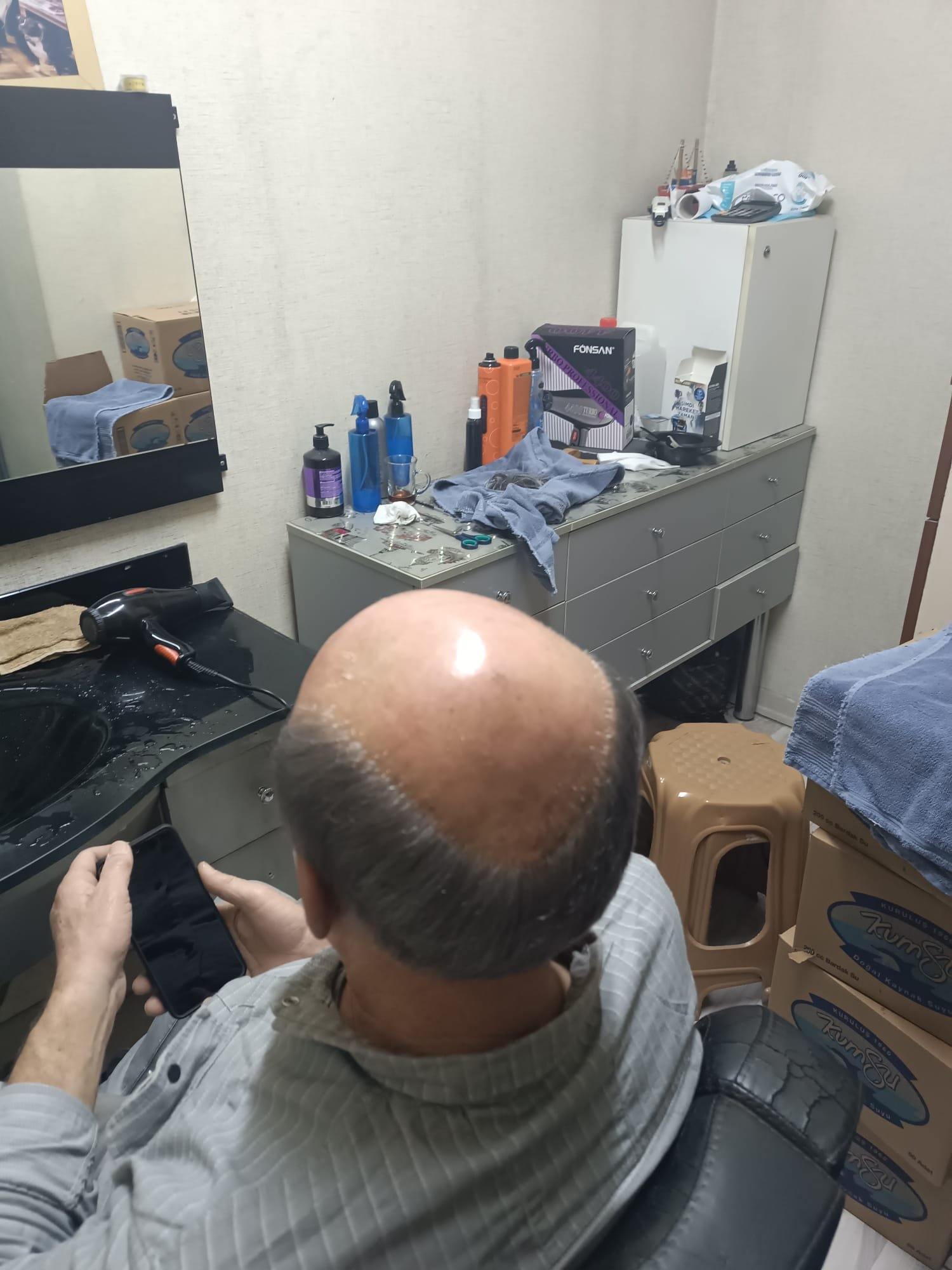 Danışan 01 protez saç çalışması — Eko Hair İstanbul
