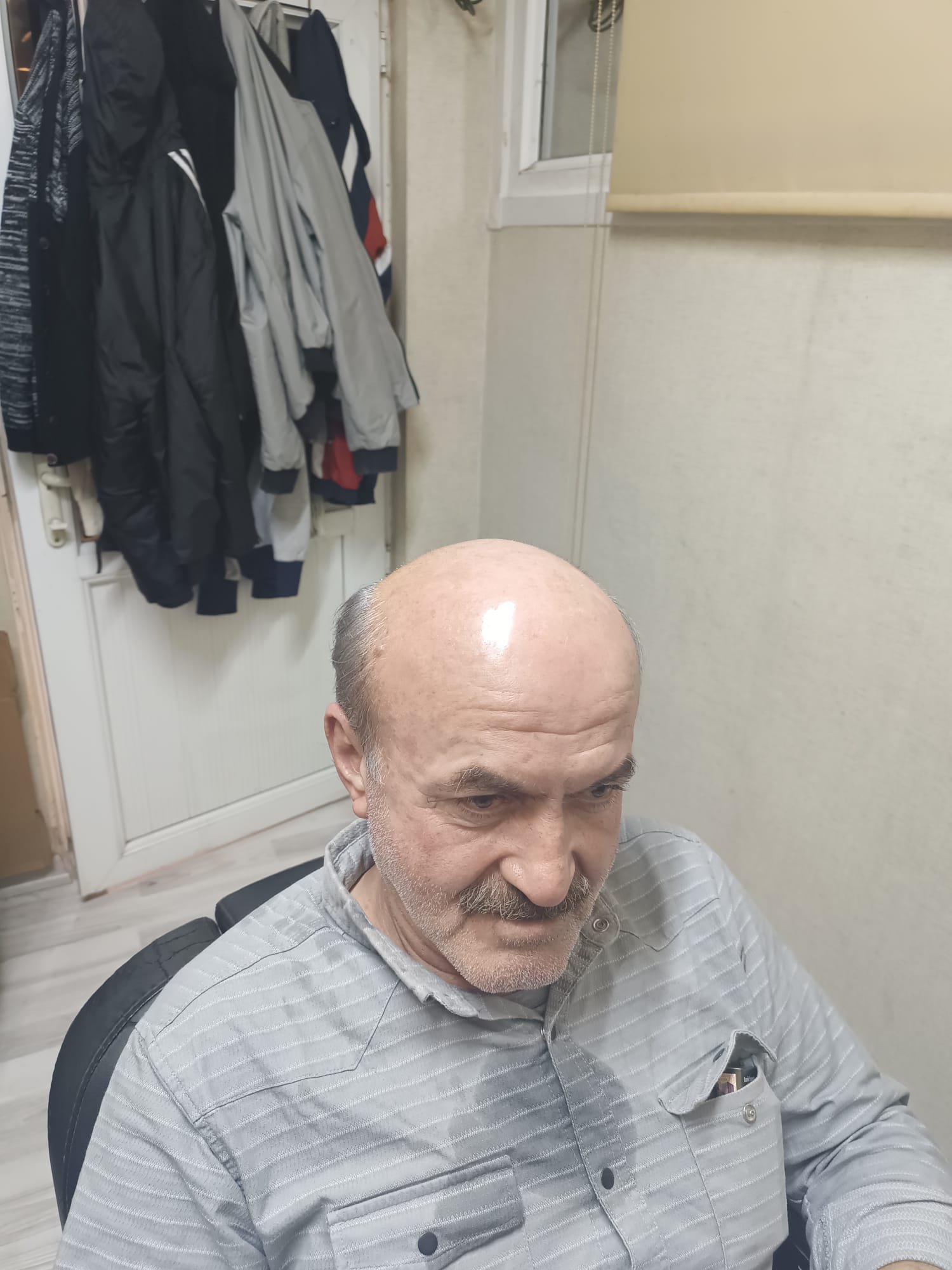 Danışan 01 protez saç çalışması — Eko Hair İstanbul