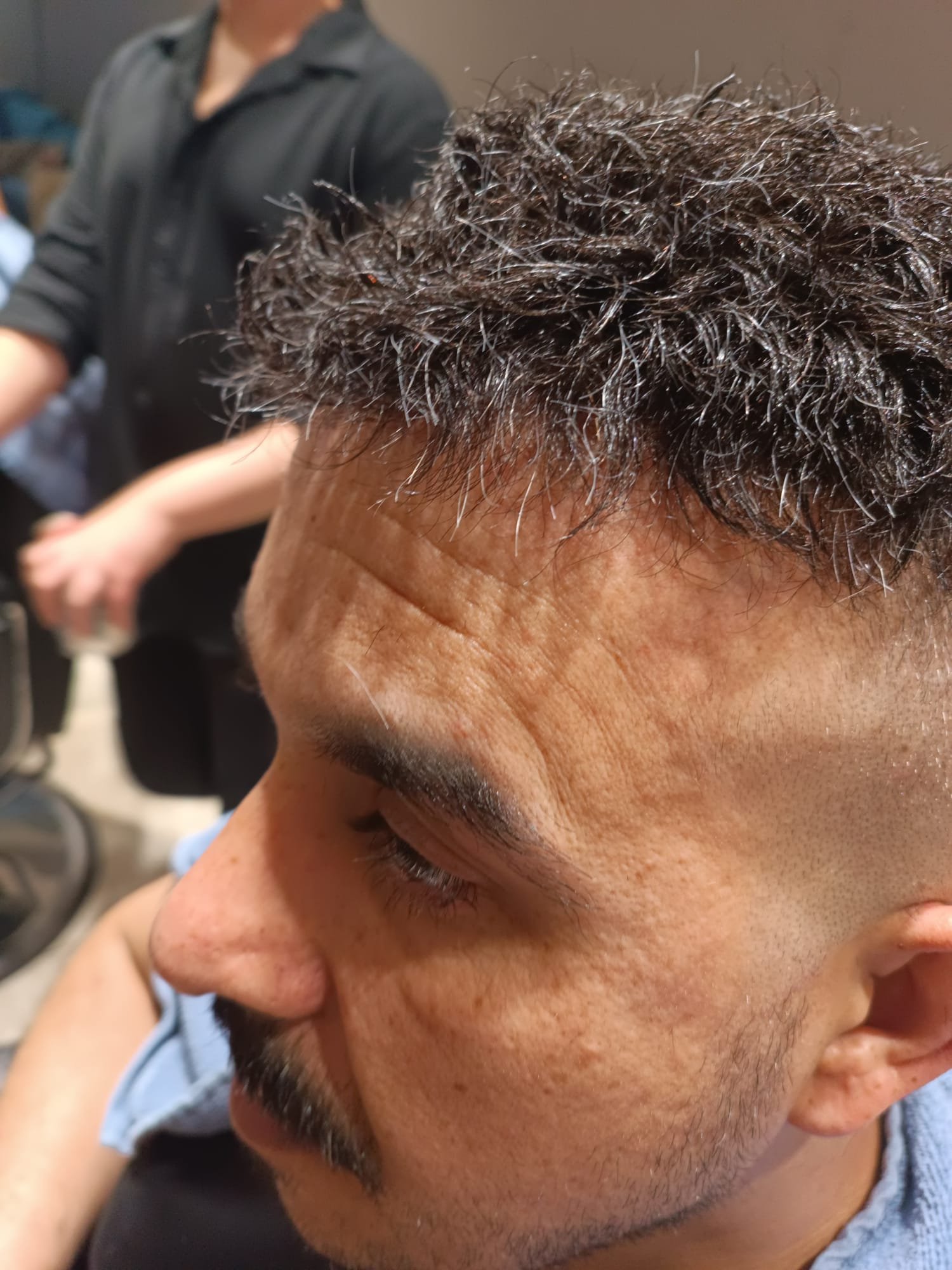 Danışan 03 protez saç çalışması — Eko Hair İstanbul