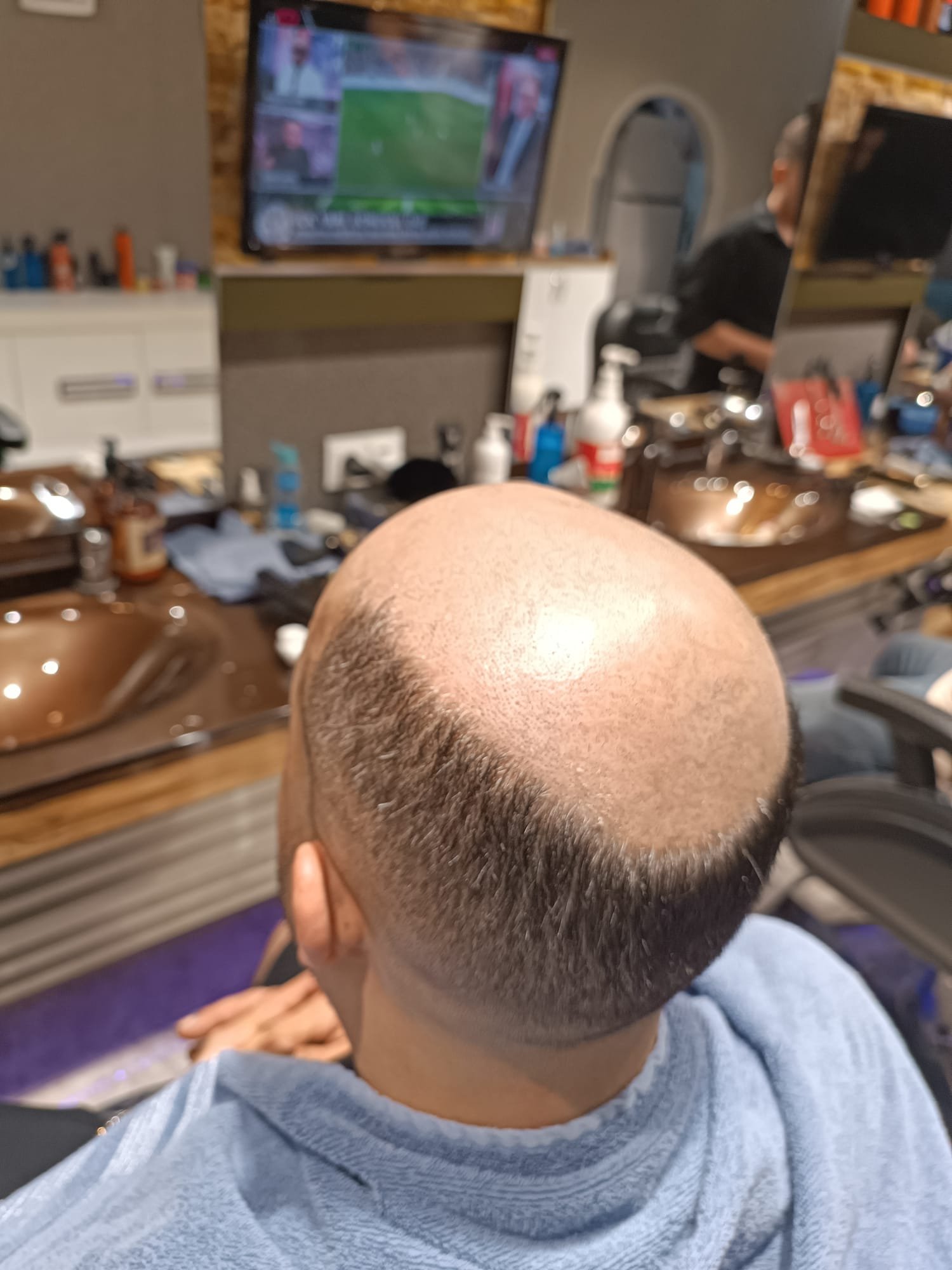 Danışan 03 protez saç çalışması — Eko Hair İstanbul